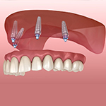 dental implants dubai | all on 6 dental implants | best dental implants in dubai | best implantologist in dubai | all on 4 dental implants dubai