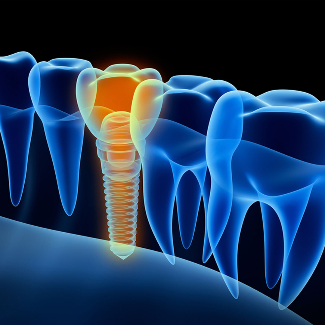 dental implants dubai | all on 6 dental implants | best dental implants in dubai | best implantologist in dubai | all on 4 dental implants dubai