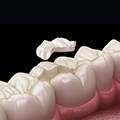 root canal treatment in dubai |root canal specialist dubai | wisdom tooth extraction dubai | oral and maxillofacial surgeon dubai | maxillofacial surgery dubai | root canal treatment under microscope | oral surgeon dubai |