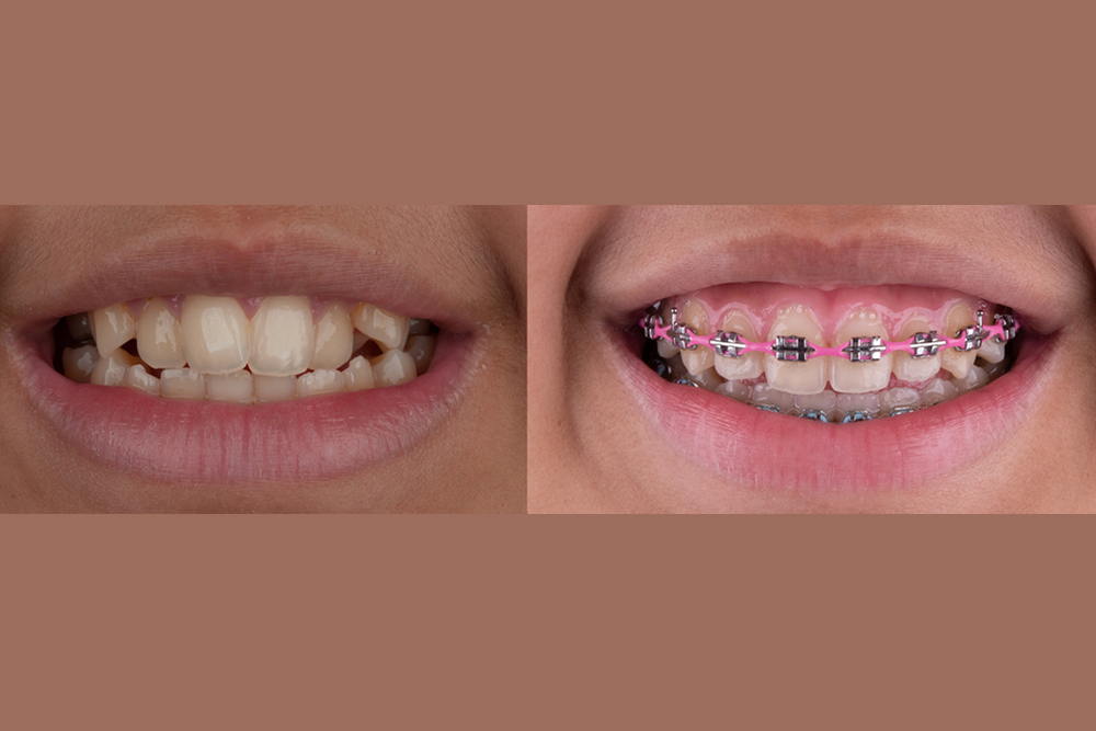 dental braces in dubaidental braces in dubai | dental braces in dubai | invisalign braces dubai | invisible braces dubai