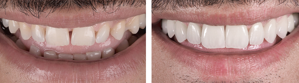laser teeth whitening dubai | best dental implants in dubai | dental crowns dubai | porcelain veneers dubai | dental veneers in dubai | general dentistry dubai