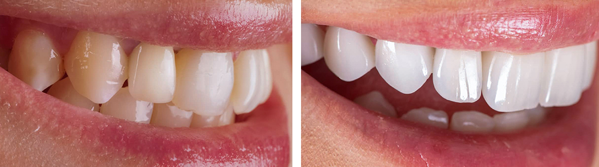 laser teeth whitening dubai | best dental implants in dubai | dental crowns dubai | porcelain veneers dubai | dental veneers in dubai | general dentistry dubai